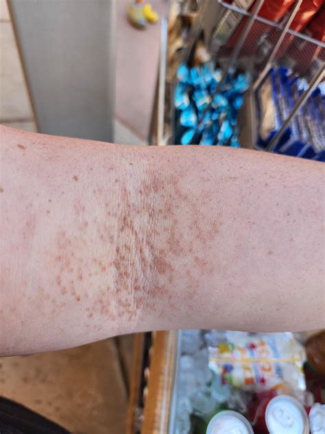 I have this rash on both inner elbow,under breasts and armpits. Dermatologist said not dangerous ...