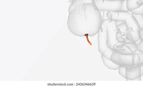 Image result for Perforated Appendix