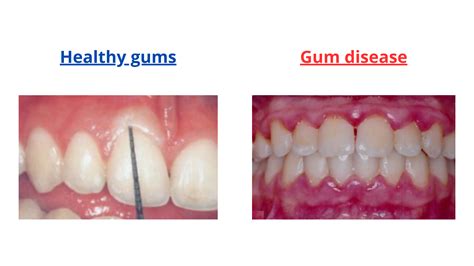Receding Gums vs Healthy Gums: See the Differences with Images