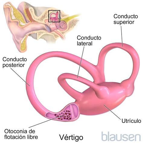 Vértigo posicional paroxístico benigno - Trastornos ...