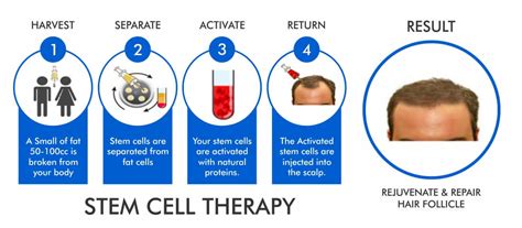 Stem Cell Therapy | Regain Hair Clinic