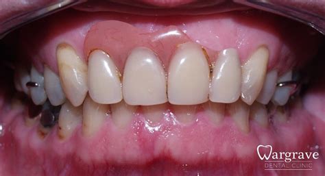 Image result for Front Teeth Partials Options