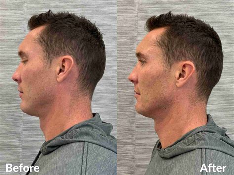 Male Jawline Sculpting Treatments at Aesthetica