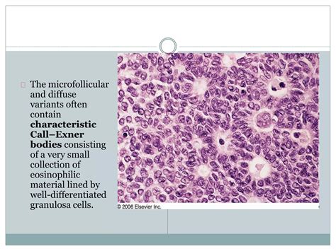 Sex cord stromal tumors- PATHOLOGY | PPTX