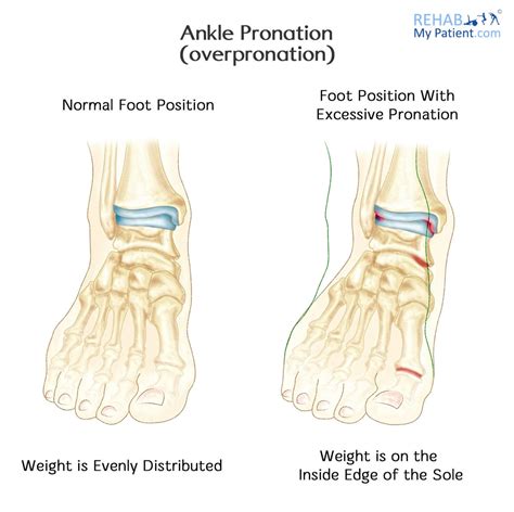 Ankle Pronation (Overpronation) | Rehab My Patient