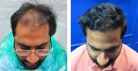 FUE Hair Transplant