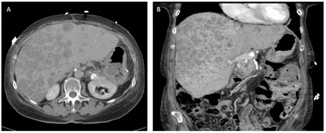 Contemporary Approaches to the Surgical Management of Pancreatic ...