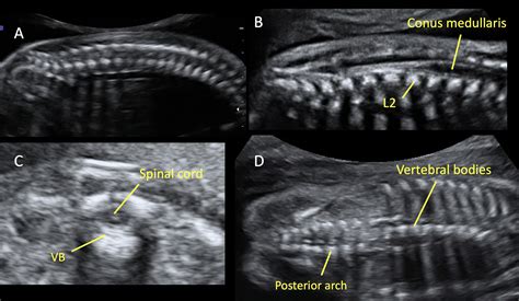 Ultrasound Evaluation of the Neural Tube | Article | GLOWM