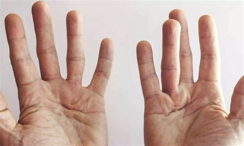 Collagenase Injection More Effective Than Needle Fasciotomy for Primary ...