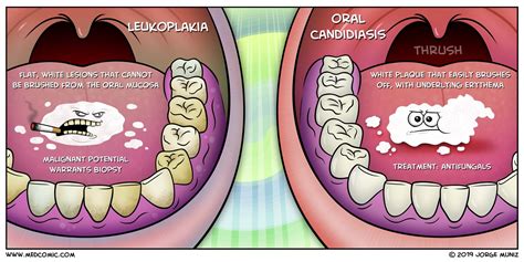 Leukoplakia Buccal Mucosa