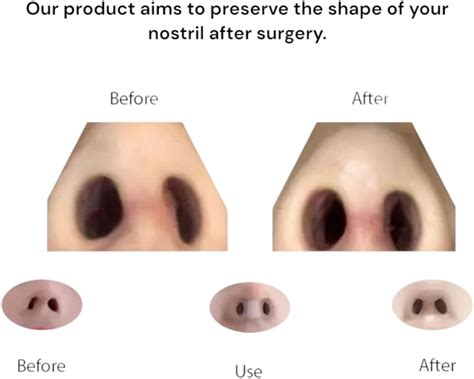NANOVITA Premium Nostril Retainer For Rhinoplasty + Tape – India | Ubuy