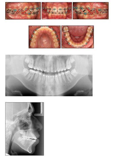 Molar Incisor Hypomineralisation—To Extract or to Restore beyond the ...