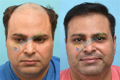 Hair Transplant Before After Result - Boosted FUE Technique - Result ...