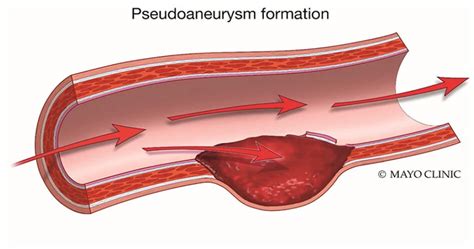 Pseudoaneurysm Treatment in Lucknow | Kayakriti