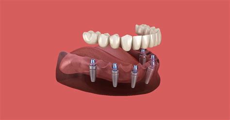 Dental Implants Adult Dental Treatments in Ahmedabad - Tooth Soothe