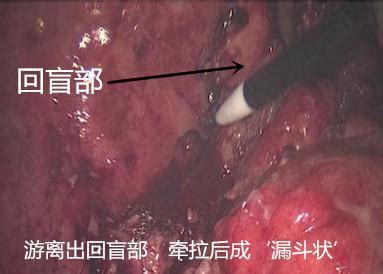 腹腔镜下阑尾根部穿孔处理经验分享（图文+视频） - 丁香园