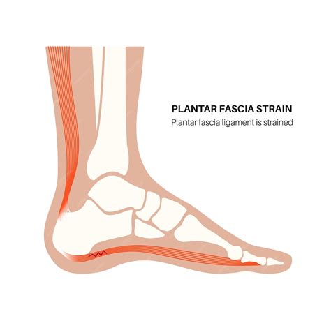 Premium Vector | Plantar fascia strain anatomical poster Tear of the soft tissue under the arch ...