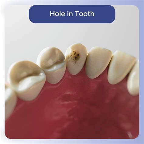Image result for Tooth Hole