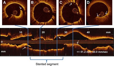 Image result for Optical Coherence Tomography Tutorial