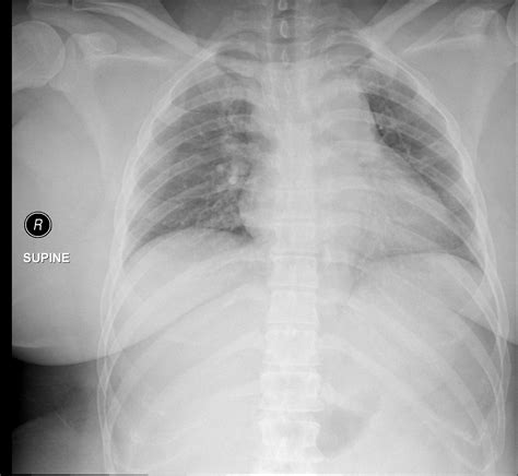 Xray Of Obese Person