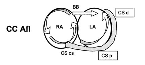 Image result for Counterclockwise Atrial Flutter