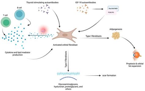 A Comprehensive Review of Thyroid Eye Disease Pathogenesis: From Immune ...