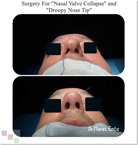 Nasal Valve Collapse and Treatment