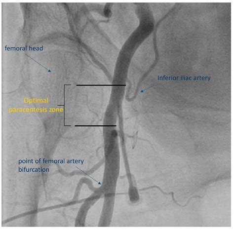Cath Lab Femoral Artery at Christina Gonzales blog