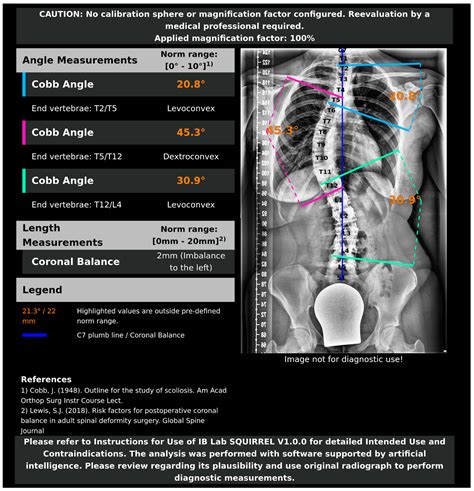 Fully Automated Measurement of Cobb Angles in Coronal Plane Spine ...