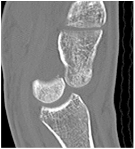 Imaging Diagnosis and Management of Carpal Trauma and Instability—An ...