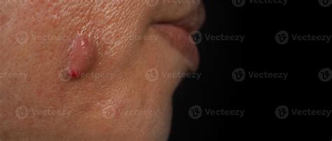 Swollen Pimple Under Skin