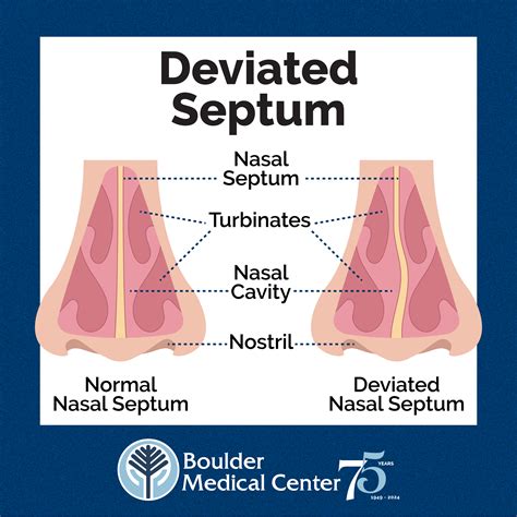 Deviated Septum: Symptoms and Treatments - Boulder Medical Center