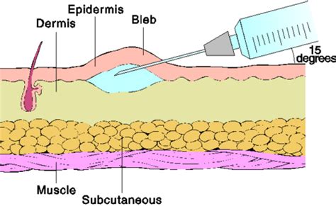 Intradermal vs Subcutaneous Injection 的图像结果