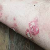 The Impact of Psoriasis on Women's Health and Wellbeing | Clinikally