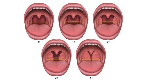 Pediatric Tonsillectomy and Adenoidectomy - OpenAnesthesia