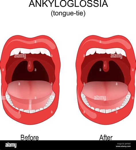 Lingual frenulum child hi-res stock photography and images - Alamy