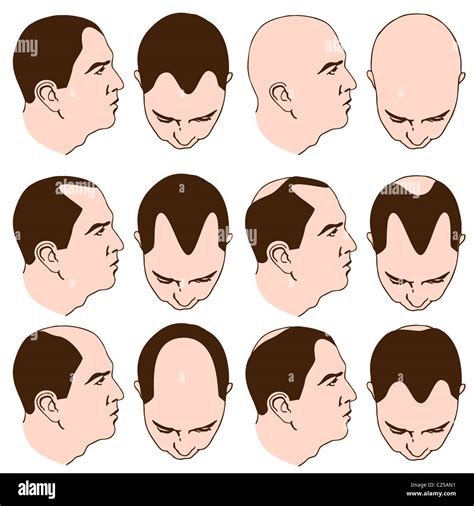 An image of man with various receding hairlines Stock Photo - Alamy