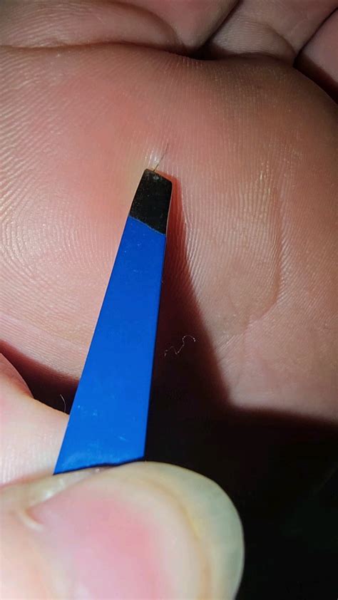 Image result for Hair Splinter Infection