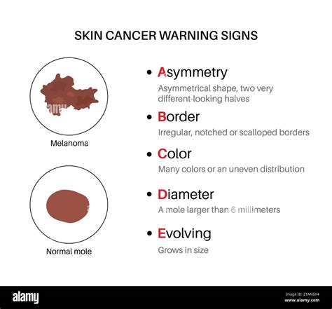 What Are Warning Signs Of Melanoma at James Browning blog