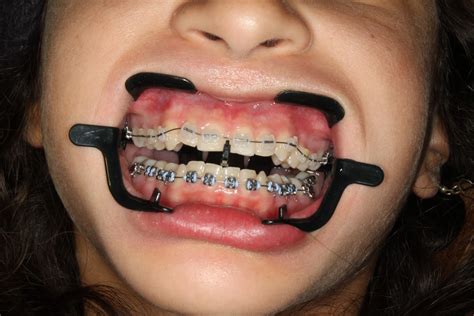 Bales Orthodontics: The TROOTH of the Matter: "Will Putting on my Braces Hurt?"