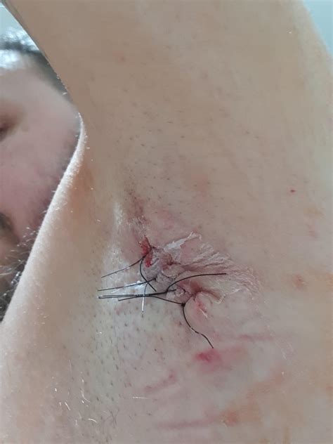 Cysts In Armpit