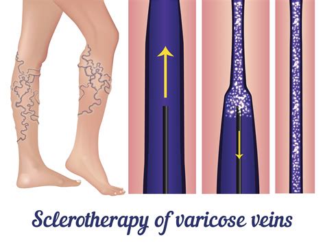 Sclerotherapy - Spider Vein Treatment - Vein Specialists of the Carolinas