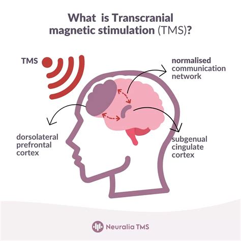 TMS - What is Transcranial Magnetic Stimulation Therapy?
