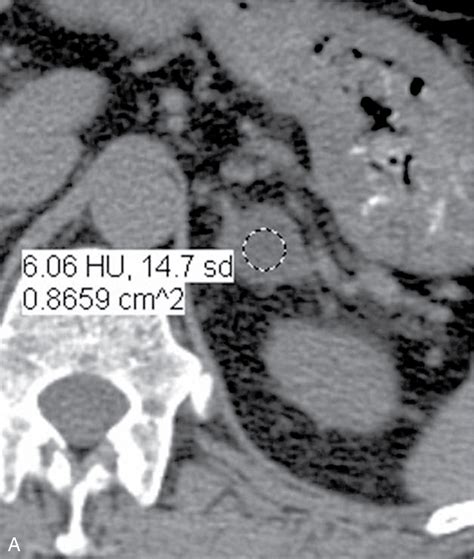 Adrenal gland enlargement and nodules | Radiology Key