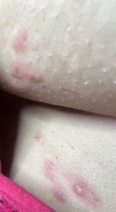 Under boob rash : r/medical_advice