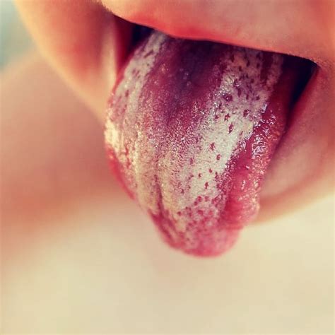 Kuvatulokset haulle candida