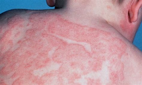 Skin Specialist in Dehradun, Skin Doctor in Dehradun