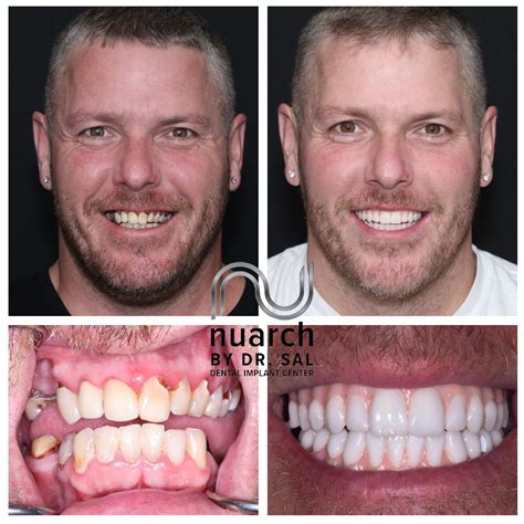 Full Dental Implants Before And After Dental Implants Nashua NH