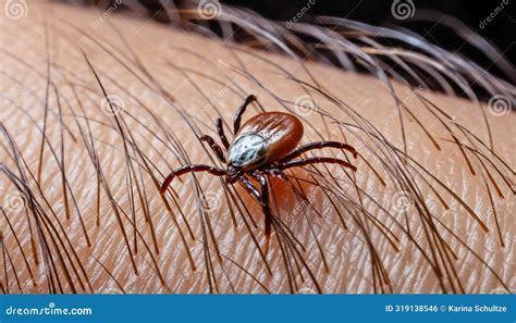 Image result for Embedded Deer Tick