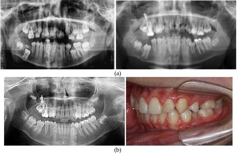 X Ray Pictures Of Jaw Bone Cancer at Eileen Towner blog